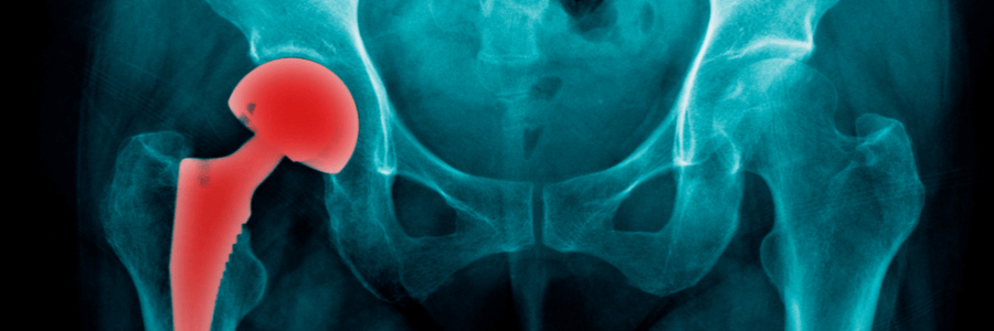 Defective metal on metal hip implant