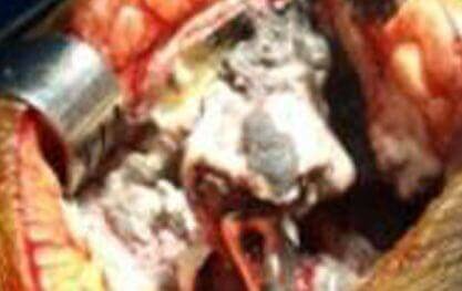 ALVAL from Metal on Metal Hip Replacement