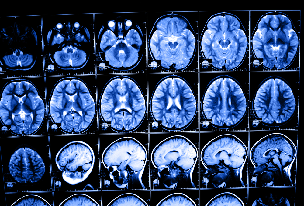 Medical images of brain