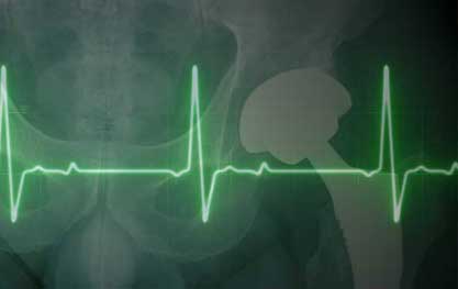 Heart issues due to metal on metal hip replacements