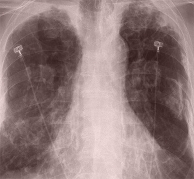Asbestosis Settlements